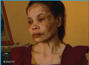 The side effects of bleaching creams. Still from an episode of Jessica 